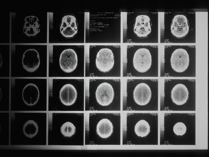 HUSin väitöstutkimus: Psykososiaaliset tekijät liittyvät lievästä aivovammasta toipumiseen