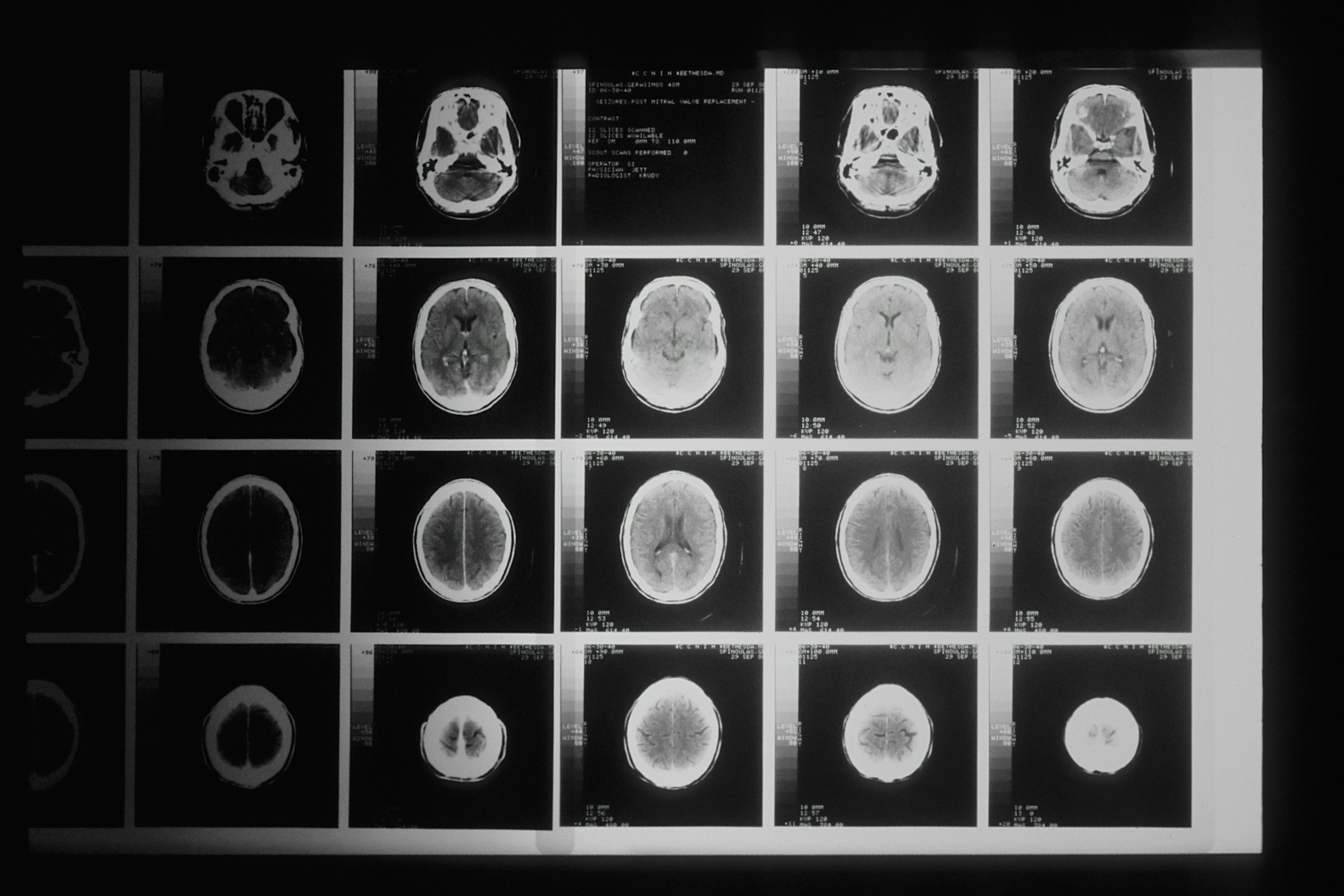 HUSin väitöstutkimus: Psykososiaaliset tekijät liittyvät lievästä aivovammasta toipumiseen